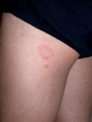 Sonnenallergie Ursachen Verlauf Und Behandlung Minimed At Sonnenallergie Ursachen Verlauf Und Behandlung Minimed At