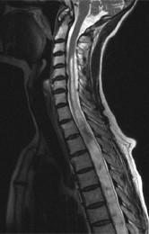 Syringomyelie a - (MRT, Schulterschmerzen, Rückenmark)