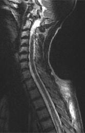 Syringomyelie b - (MRT, Schulterschmerzen, Rückenmark)