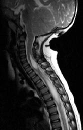 Syringomyelie c - (MRT, Schulterschmerzen, Rückenmark)