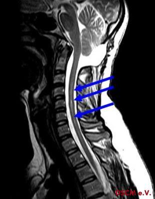 Syringomyelie - (MRT, Schulterschmerzen, Rückenmark)