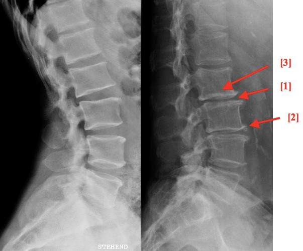 Röntgenbild HWS (Orthopädie, Röntgen)