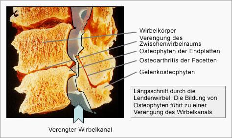 deg. Wirbel - (Orthopädie, HWS, Röntgen)
