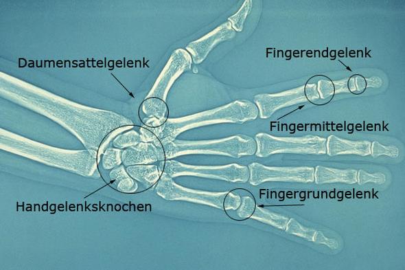 Hand 1 - (Befund, Fingerluxation)