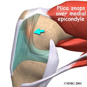 Plica - (Knie, Orthopädie, Befund)