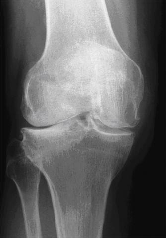 11monate Nach Kreuzband Op Operation Sport Knie 11monate Nach Kreuzband Op Operation Sport Knie