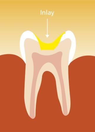 Grafik Füllung (auch Inlay genannt) - (Zähne, Zahnbehandlung, Plombe)