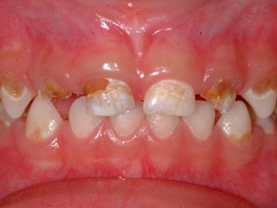 Karies im Fortgeschrittenen Stadium  - (Zahnpflege, Karies, Milchzähne)