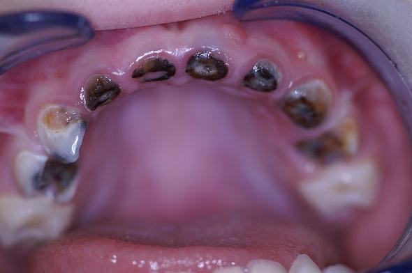 Zähne regelrecht weggefault - (Zahnpflege, Karies, Milchzähne)