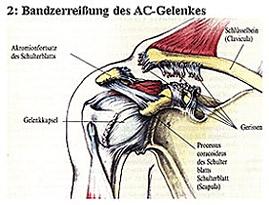 AC- Gelenk 2 (Bänderriss)  - (Schmerzen, MRT Befund, Oberarm)