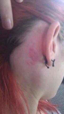 Ausschlag Am Ganzen Korper Was Konnte Das Sein Juckreiz Hautarzt Neurodermitis Ausschlag Am Ganzen Korper Was Konnte Das Sein Juckreiz Hautarzt Neurodermitis