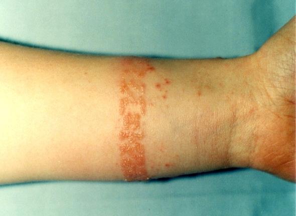 Was Sind Symptome Einer Nickelallergie Was Sind Symptome Einer Nickelallergie