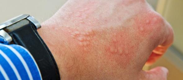 Was Sind Symptome Einer Nickelallergie Was Sind Symptome Einer Nickelallergie