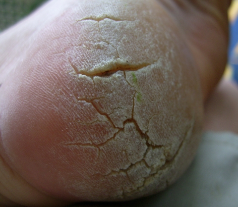 Gribok die Finger der Hände zu heilen