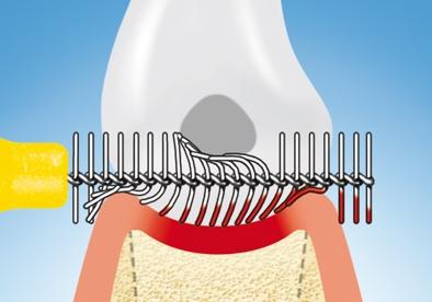 Funktionsweise Interdentalbürsten - (Zähne, Entzündung, Zahntaschen)
