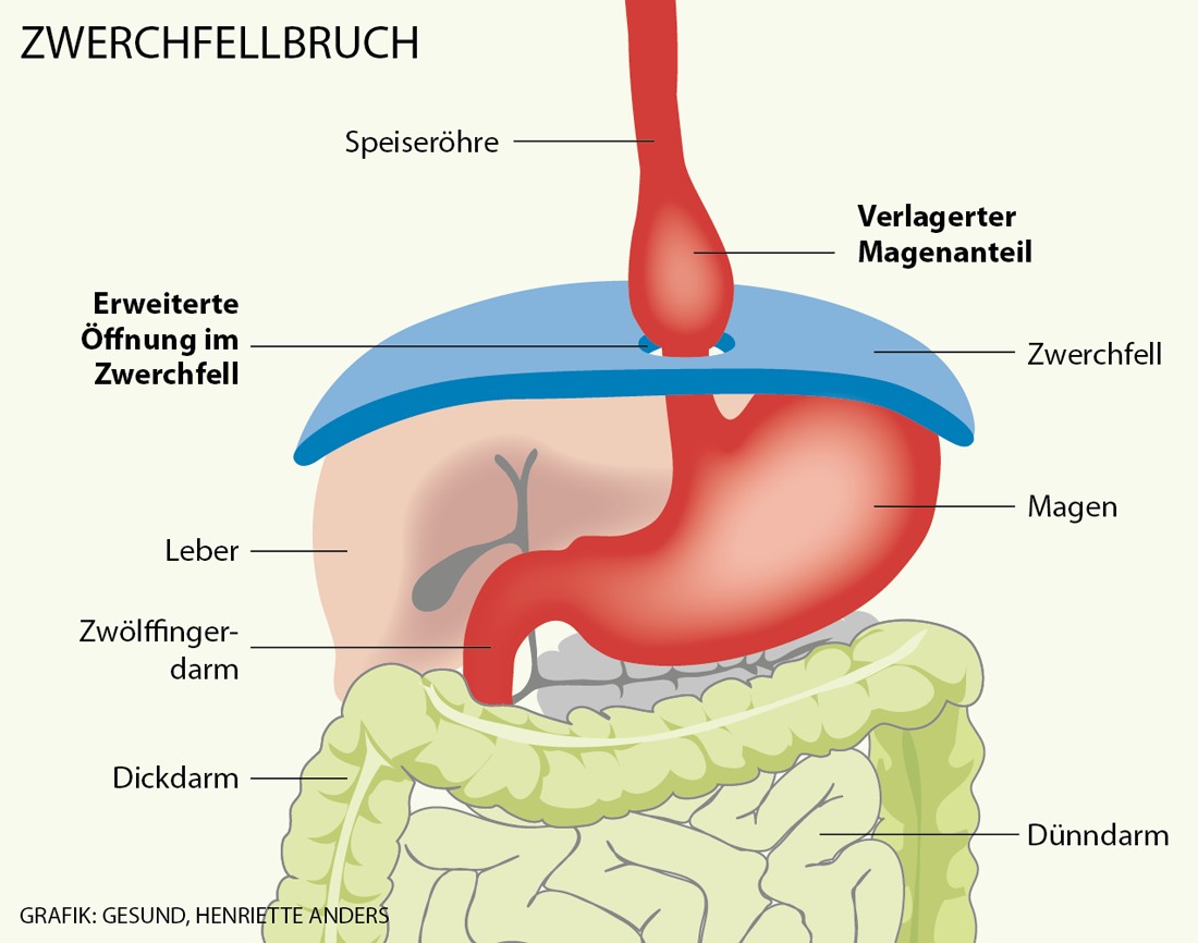 Magenbruch und starkes Sodbrennen Magenbruch und starkes Sodbrennen