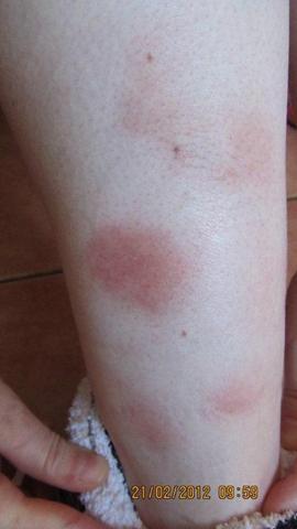 rote Flecke 3 - (Gesundheit, Beine, Flecken)