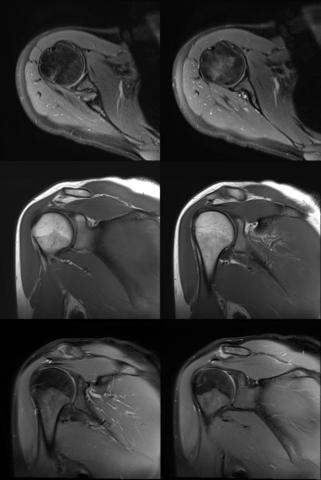 Mrt befund schulter: mrt schulter kosten – ICDK