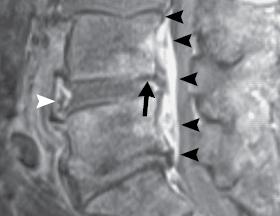 epidurale Abszess kleine Pfeile weisser und langer Pfeil Ödeme - (MRT, Metastasen)