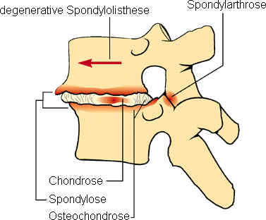 Die Osteoporose der Halswirbelsäule des Fotos