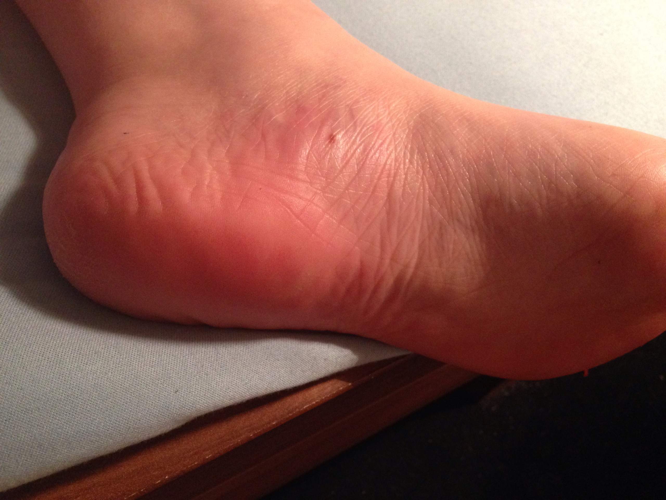 Schmerzende knoten Verhärtung an der Fußsohle (Schmerzen, Füße)