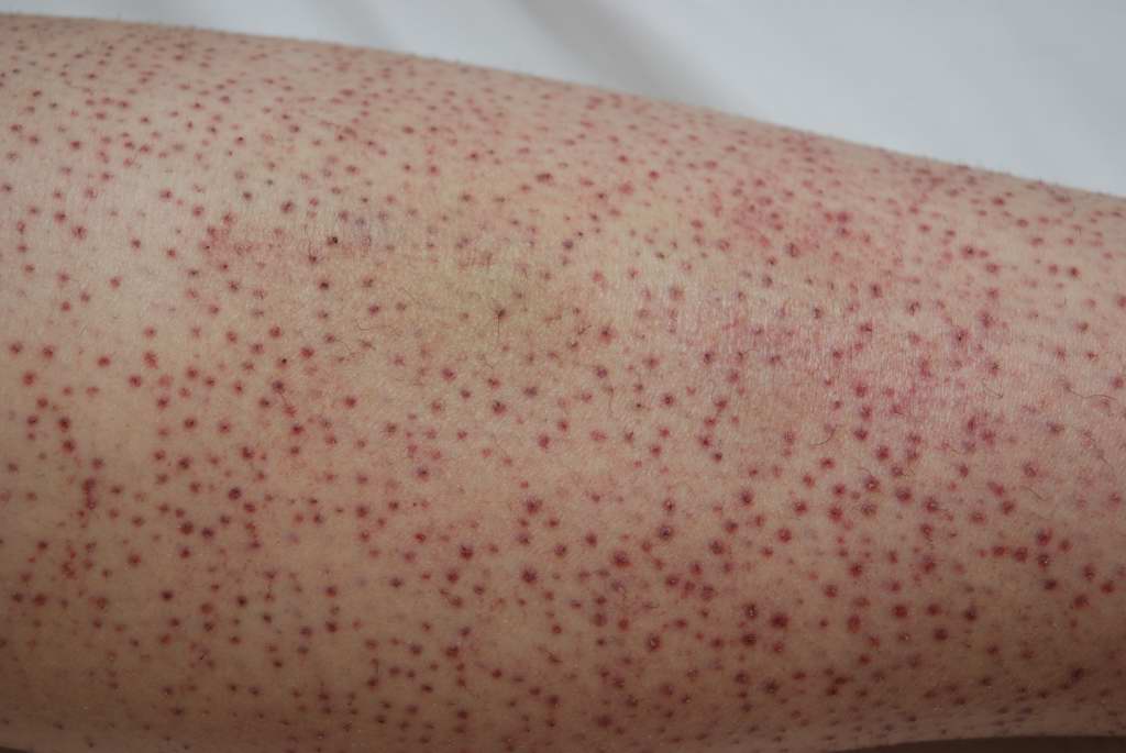 Sind das Petechien??? Hilfe!!! (Haut, Krebs)