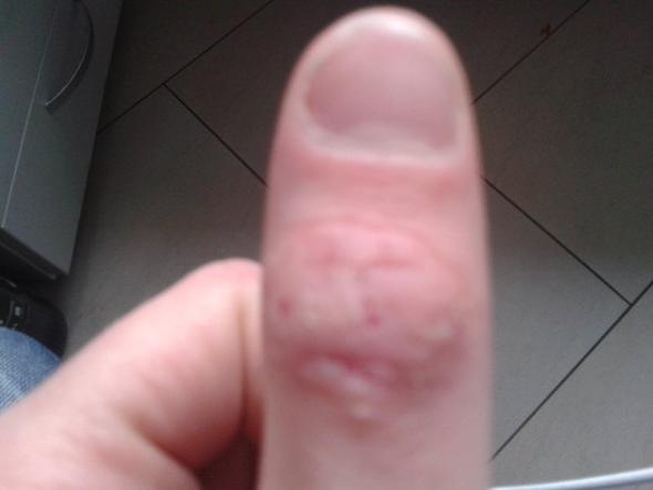 - (Hand, Krankheit, Hilfe)