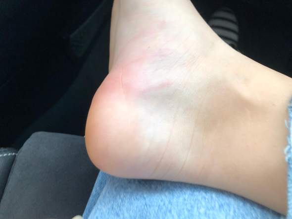 Rote Striche und Blauer harter Fleck nach Bienenstich? (Schmerzen, Flecken)