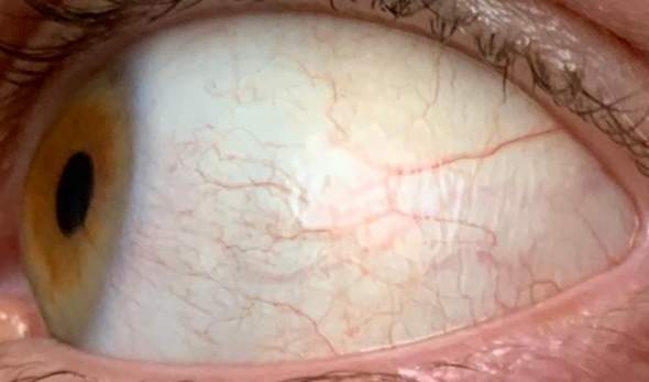 Gelbe Augen / Sklerenikterus? (Leberwerte)