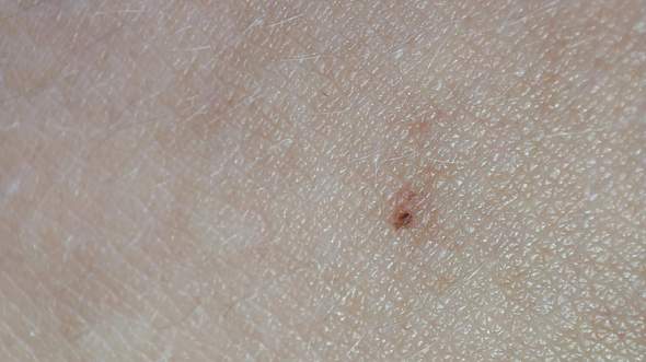 Was ist mit diesem Leberfleck? (Haut, Angst, Blut)