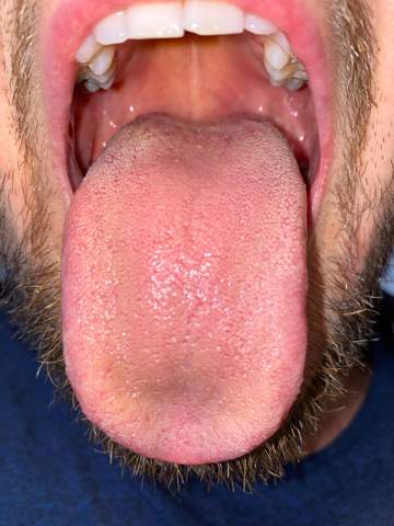 Ist Das Normaler Zungenbelag Mund Zunge Pilze Ist Das Normaler Zungenbelag Mund Zunge Pilze
