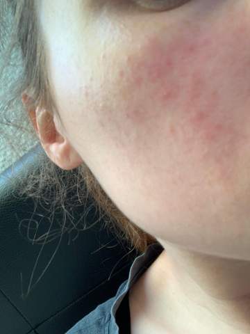 Konnte Das Ein Hautausschlag Sein Haut Gesundheit Hautprobleme Konnte Das Ein Hautausschlag Sein Haut Gesundheit Hautprobleme