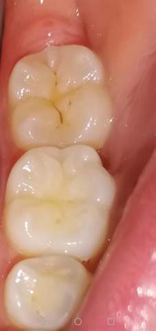 Karies Oder Nur Verfarbungen Zahne Karies Oder Nur Verfarbungen Zahne