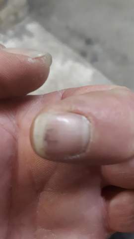 Schmerzhafte Streifen Unter Fingernageln Fingernagel Schmerzhafte Streifen Unter Fingernageln Fingernagel