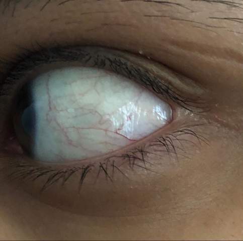 Augen Flecken Flackern Gesundheit Gesundheit Und Medizin Sehstorung Augen Flecken Flackern Gesundheit Gesundheit Und Medizin Sehstorung