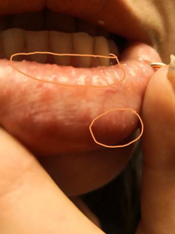 Was Sind Das Fur Blaschen An Der Innenseite Der Lippe Angst Allergie Krankheit Was Sind Das Fur Blaschen An Der Innenseite Der Lippe Angst Allergie Krankheit