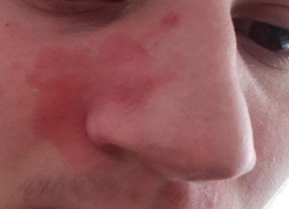 Trockene Haut Um Nase Bindet Sich Nicht Trockene Haut Um Nase Bindet Sich Nicht