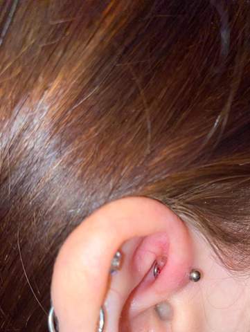 piercing blutet und grosse blase entzundung
