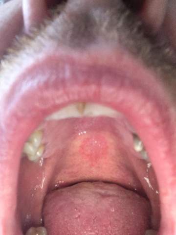 Was Ist Das Am Gaumen Was Ist Das Am Gaumen