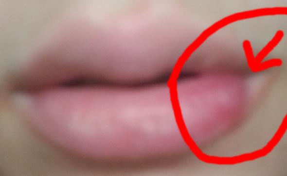 ( mit Bild ) Komischer Knubbel / Knoten in der Lippe was kann das sein?
