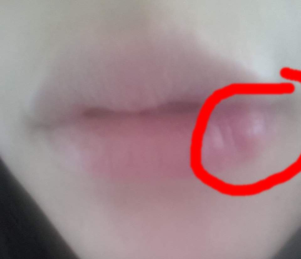 ( mit Bild ) Komischer Knubbel / Knoten in der Lippe was kann das sein? (Tumor)