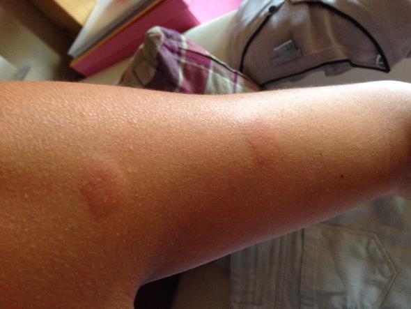 Mückenstiche - (Haut, Allergie, Schwellung)