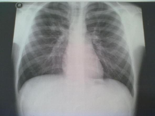 röntgenbild von donnerstag - (Kinder, Röntgen, Tuberkulose)
