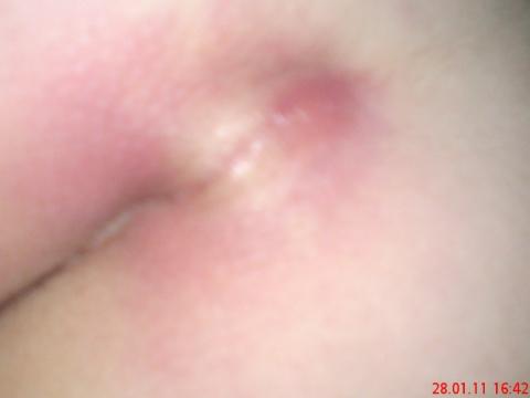 Abszess Am Steiss Lieber Op Operation Medizin Abszess Am Steiss Lieber Op Operation Medizin