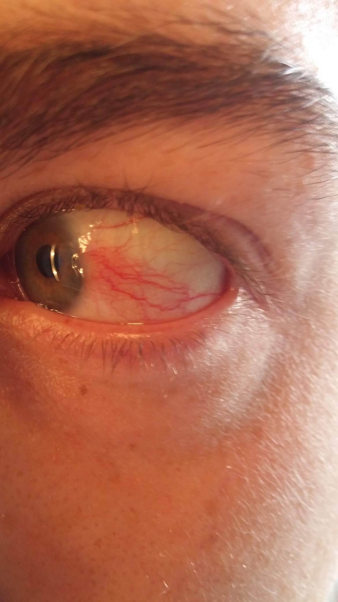 Blutfleck adern blutung bzw woher bluterguss Woher kommen die Adern bzw. Blutfleck am Auge? (Augen, blutung, Bluterguss)