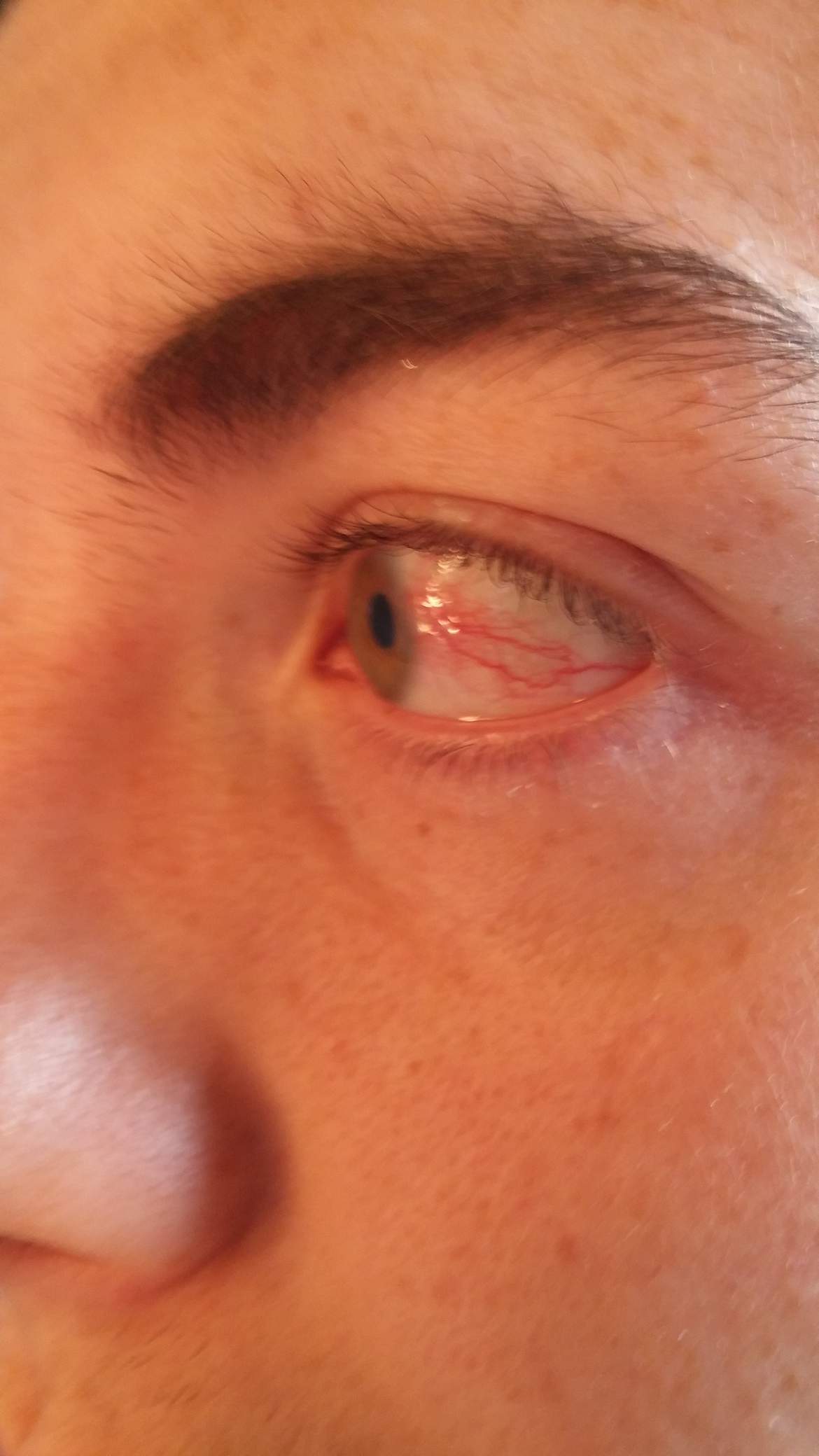 Wie Bekommt Man Ein Blaues Auge Weg