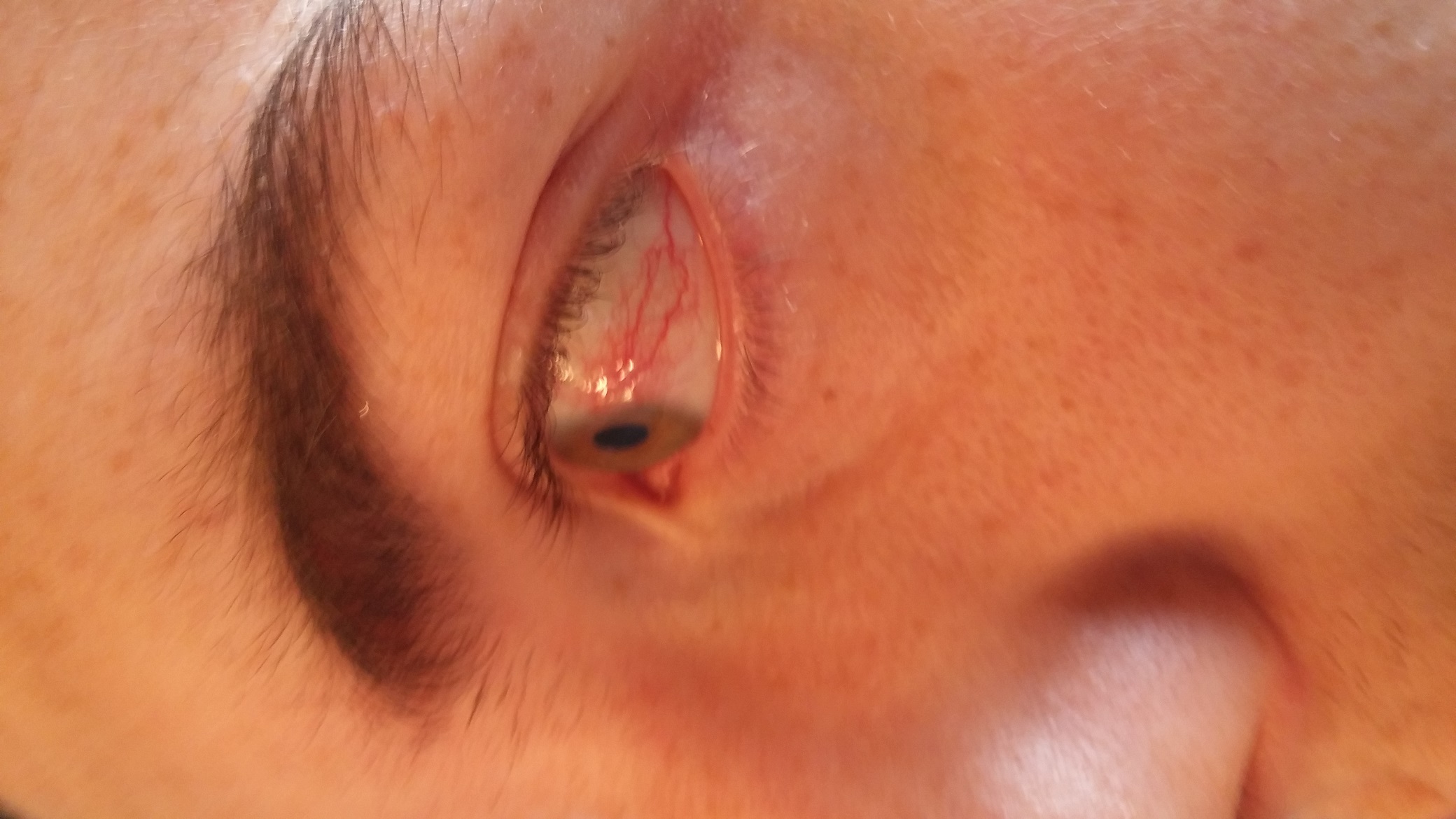 Woher kommen die Adern bzw. Blutfleck am Auge? (Augen, blutung, Bluterguss)