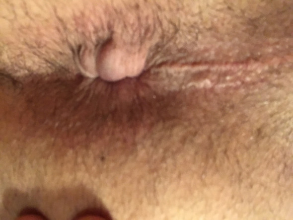 Schwellung After - (Haut, Schwellung, After)