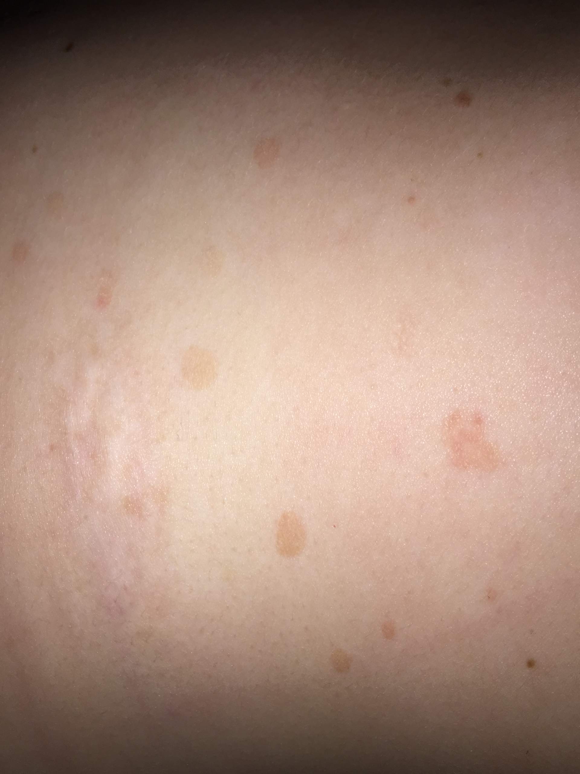 Allergie wegen schlechten Erdbeeren? (Haut, Ernährung, Ausschlag)