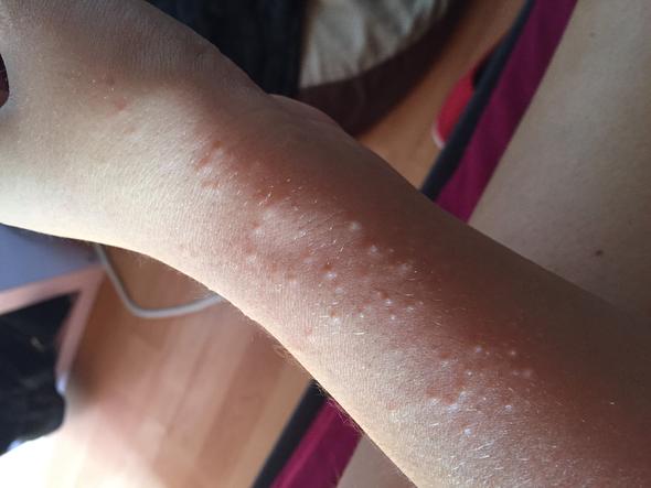 Allergische Reaktion Seid Mehreren Tagen Schon Durch Armand Was Tun Welche Medikamente Helfen Haut Behandlung Allergie Allergische Reaktion Seid Mehreren Tagen Schon Durch Armand Was Tun Welche Medikamente Helfen Haut Behandlung Allergie
